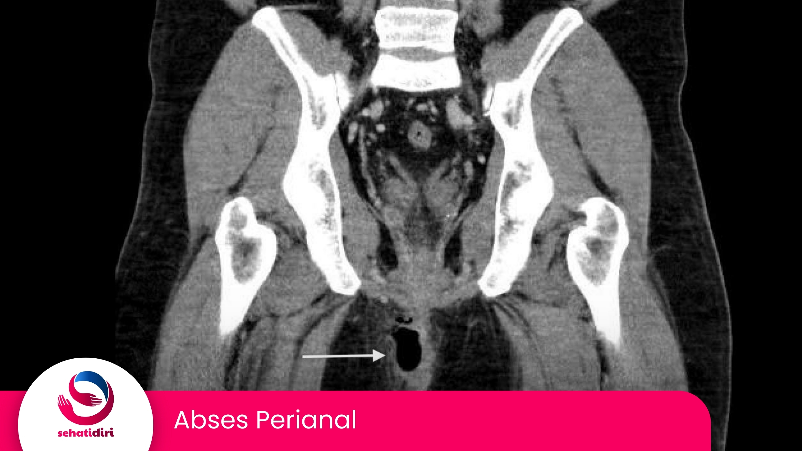 Abses Perianal