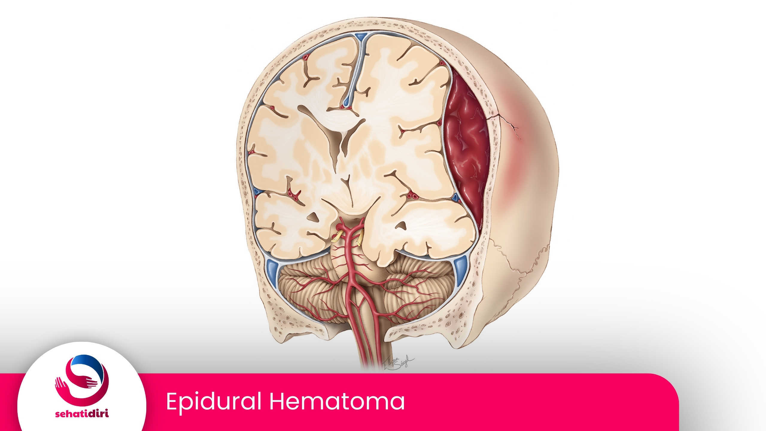 Epidural Hematoma