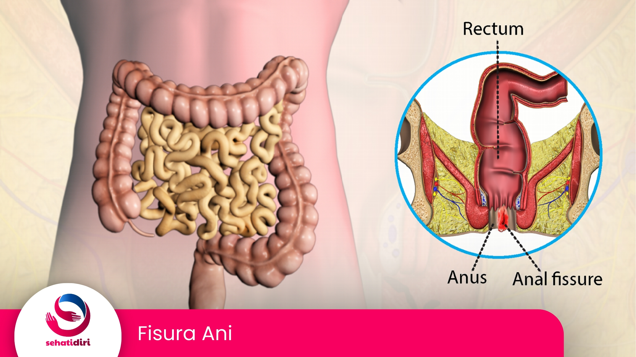 Fisura Ani