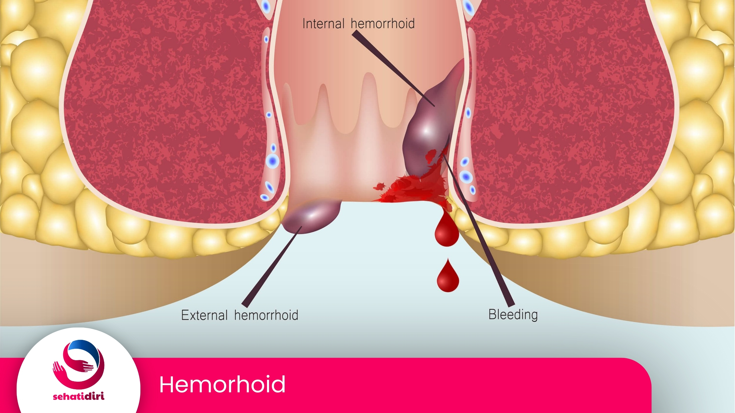 Hemorrhoid (Ambeien/Wasir)