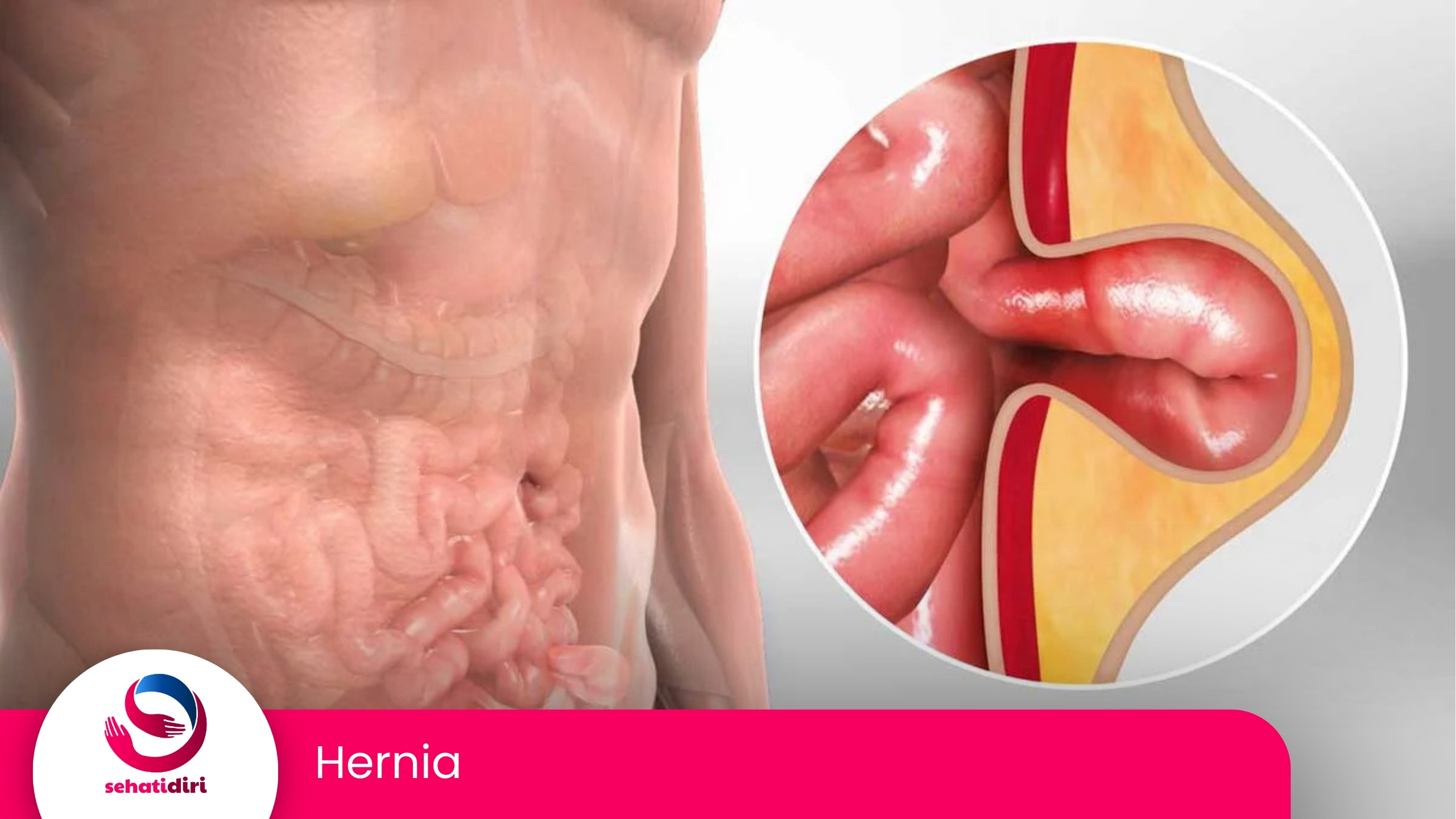 Hernia