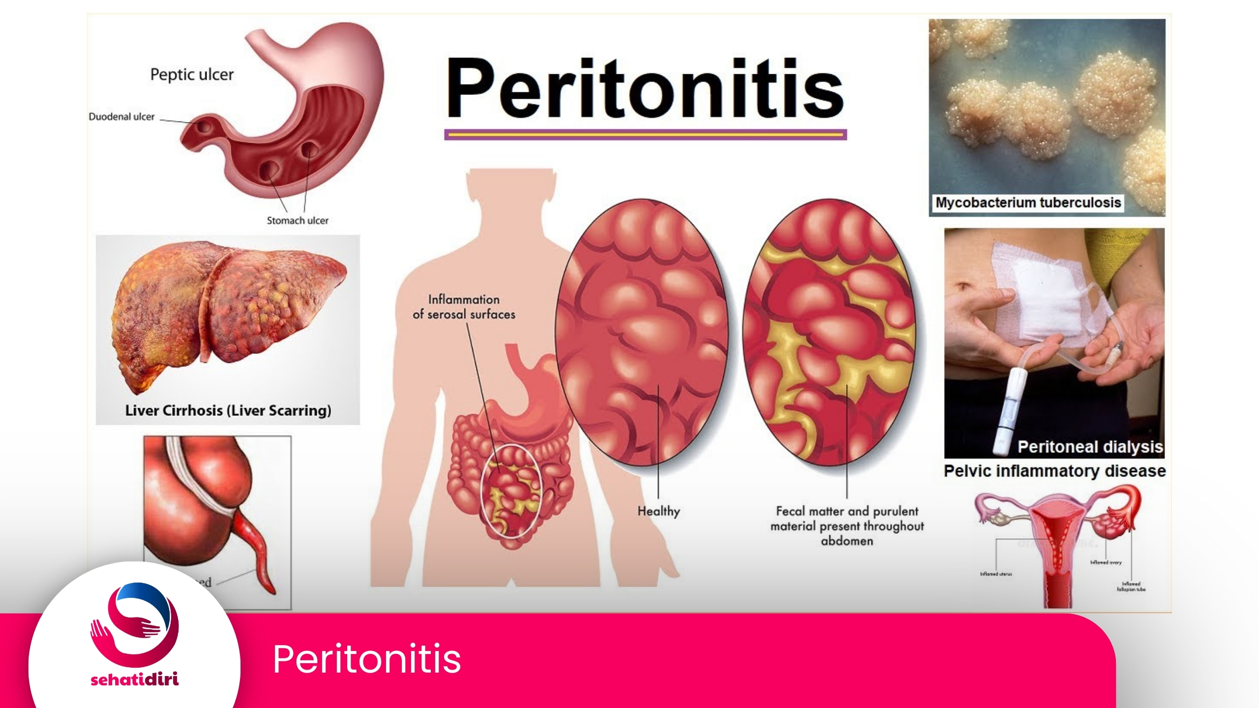 Peritonitis