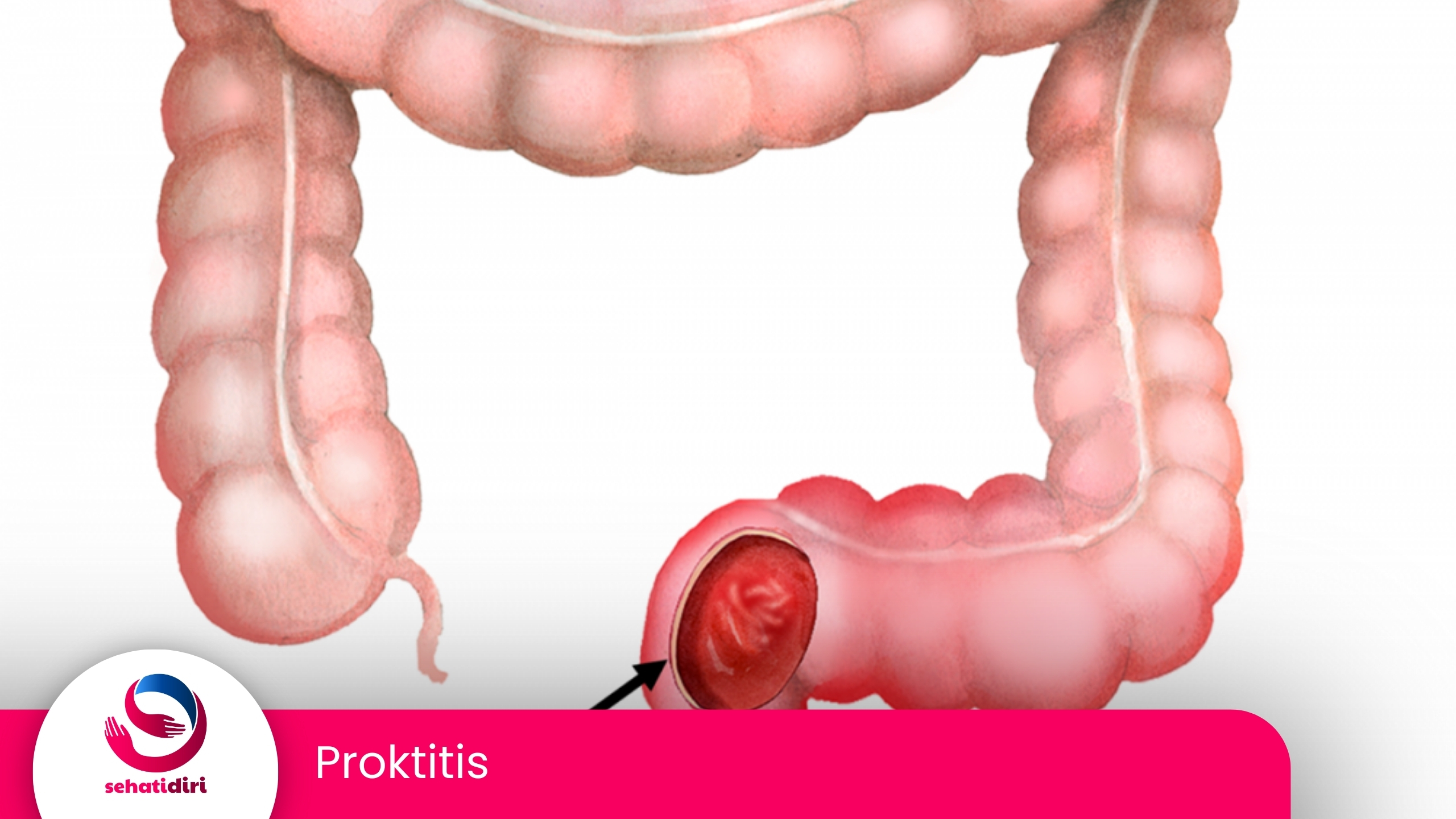 Proktitis