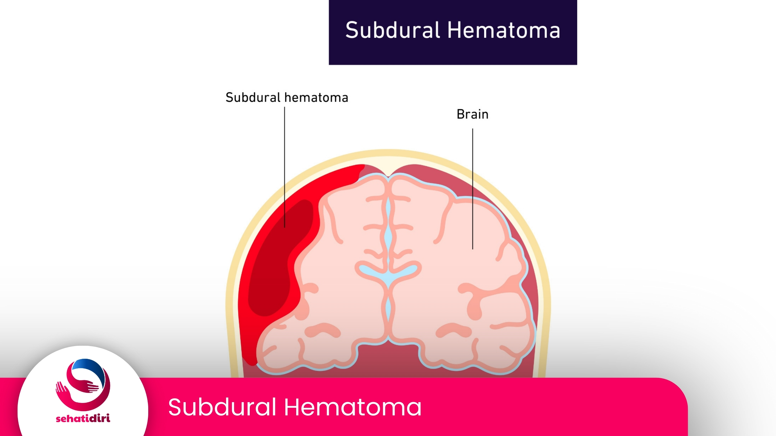 Subdural Hematoma