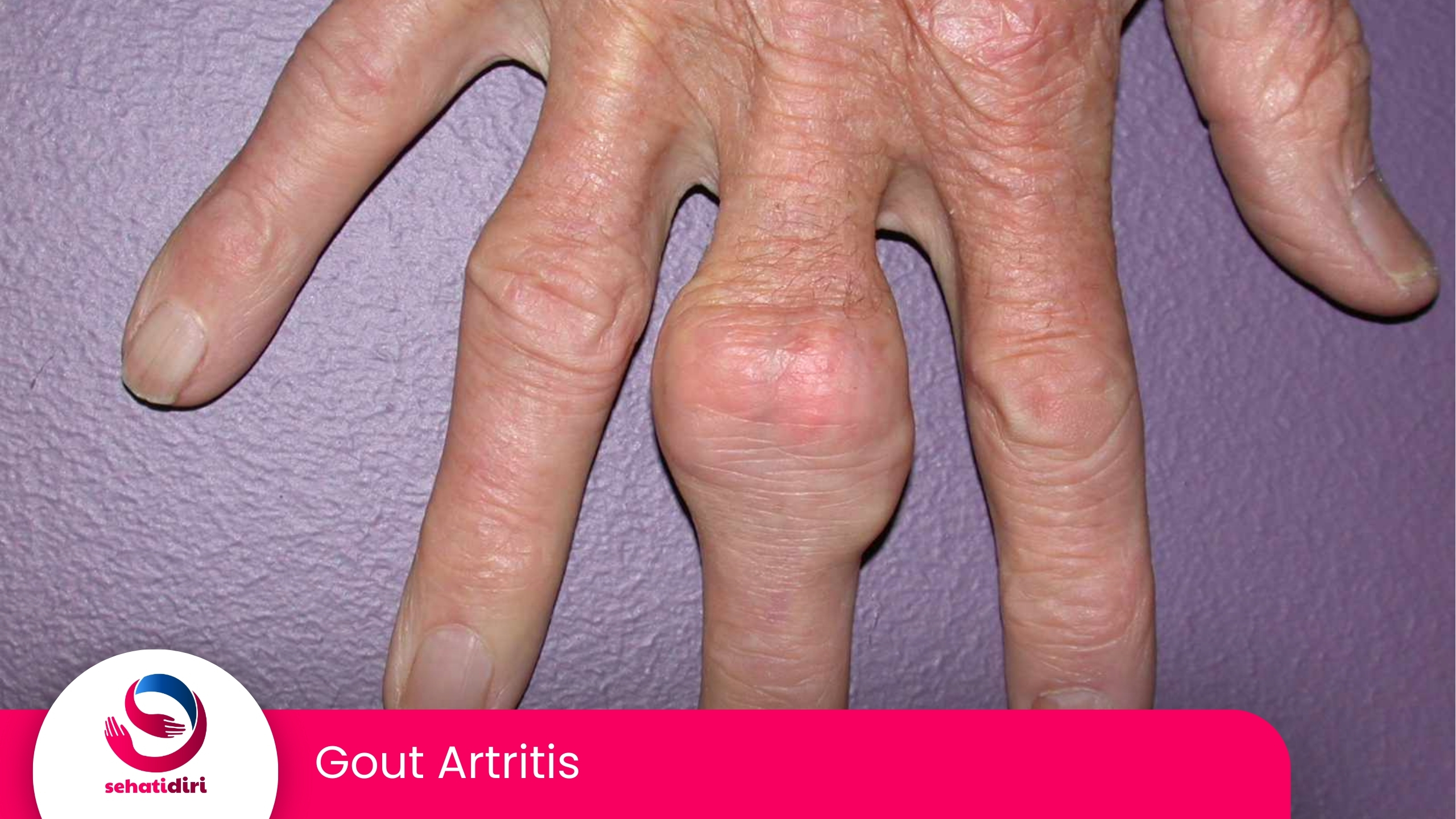 Gout Artritis