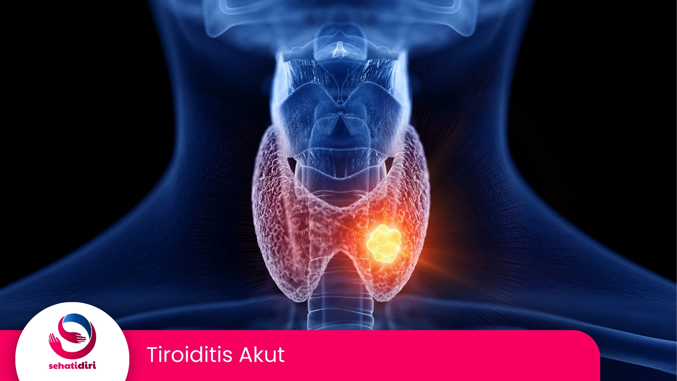 Tiroiditis Akut