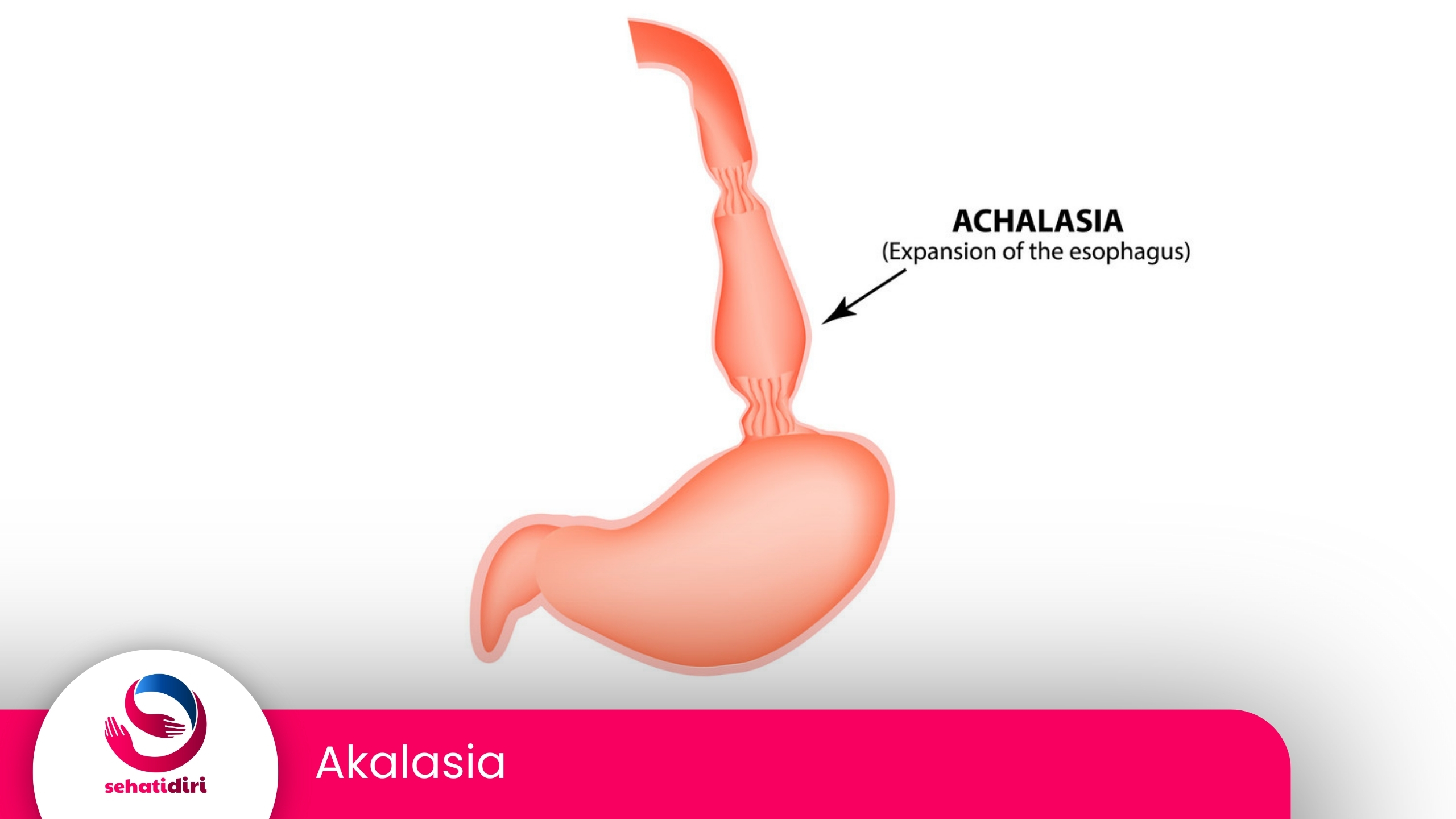 Akalasia