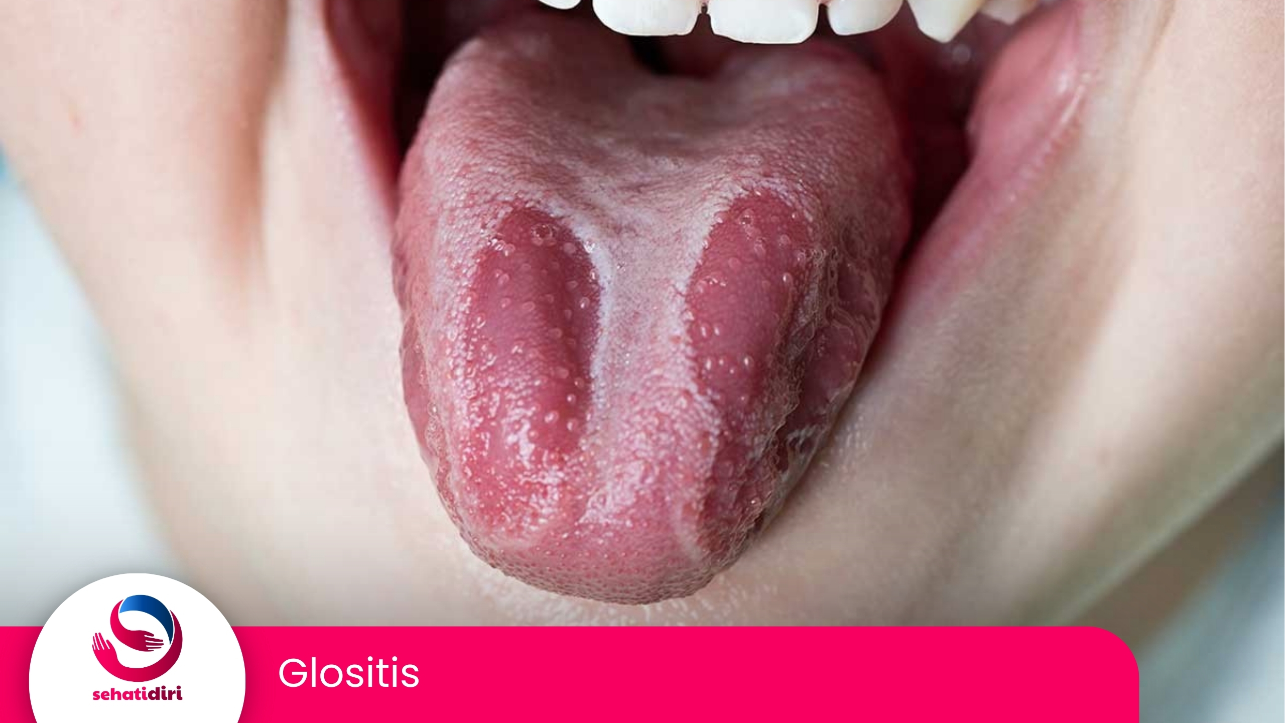 Glositis