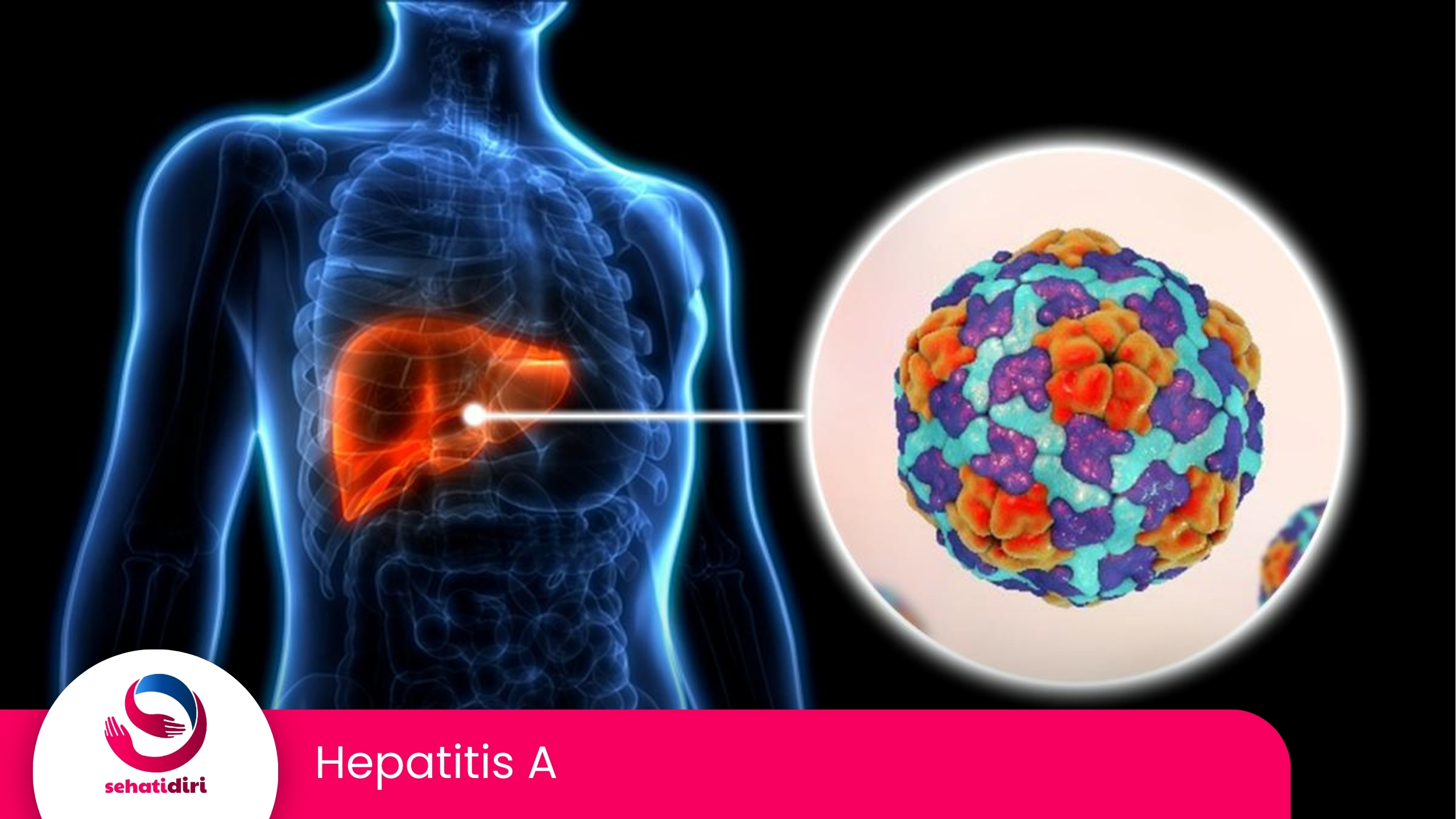 Hepatitis A