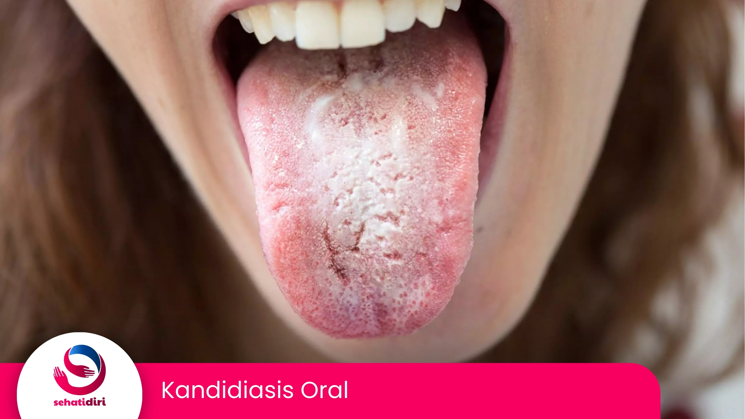 Kandidiasis Oral