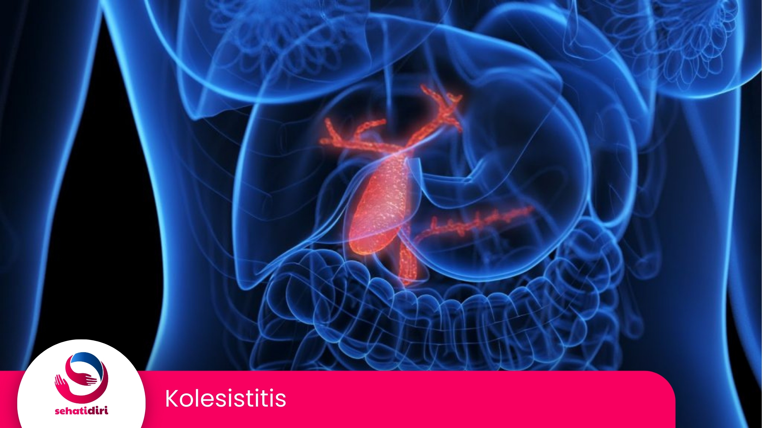 Kolelitiasis