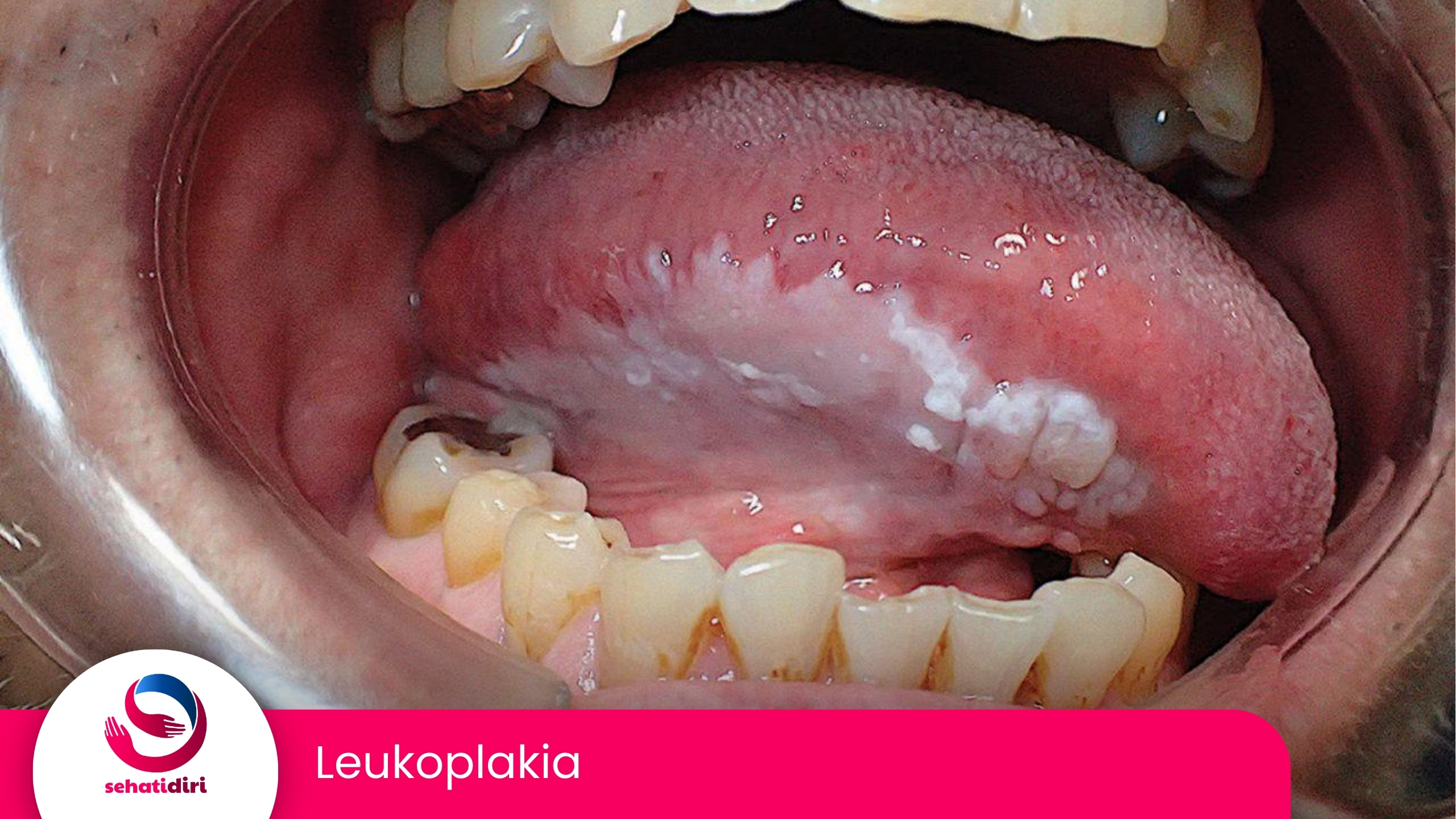 Leukoplakia