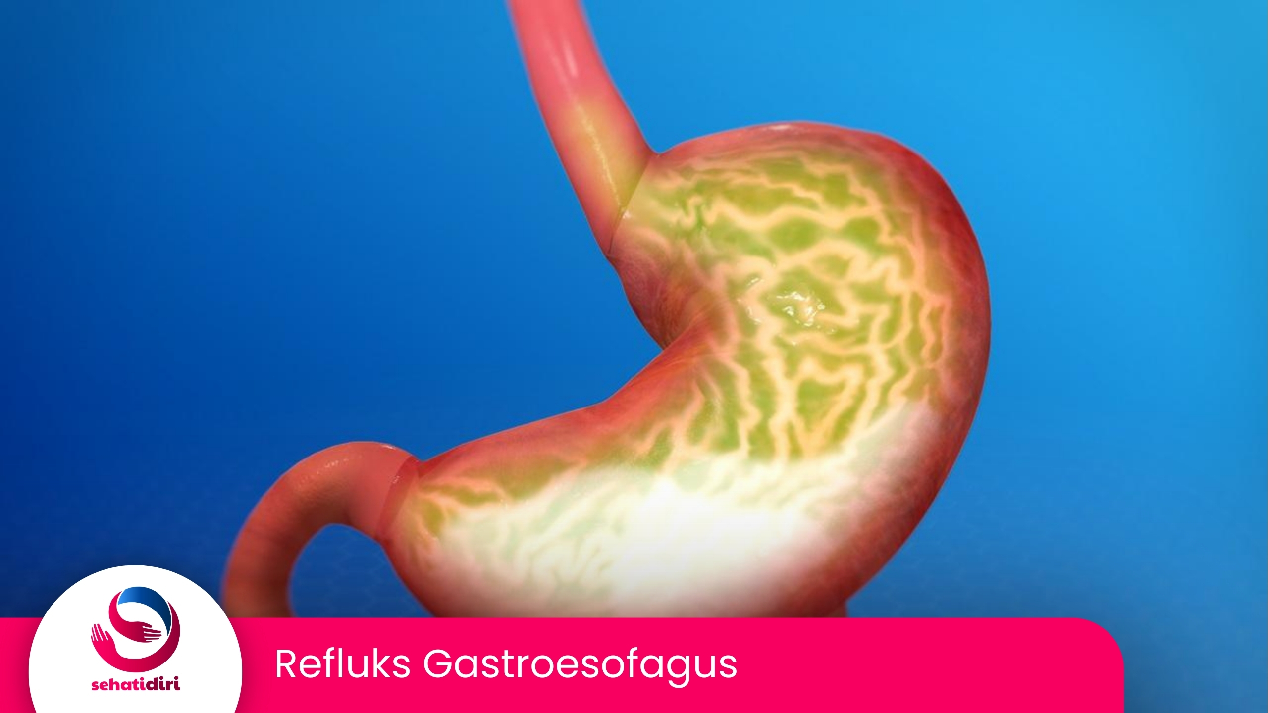 Refluks Gastroesofagus