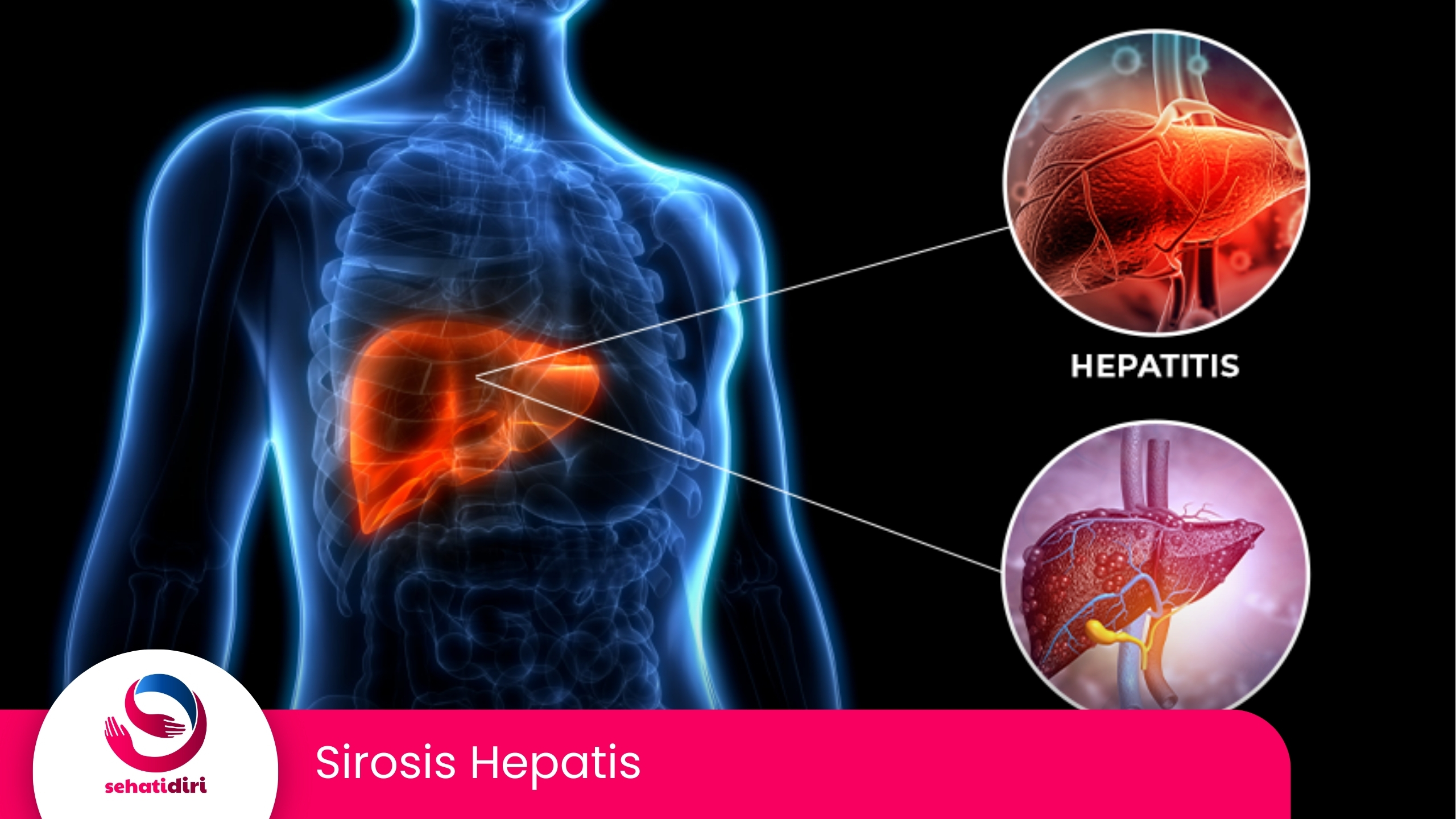 Sirosis Hepatis