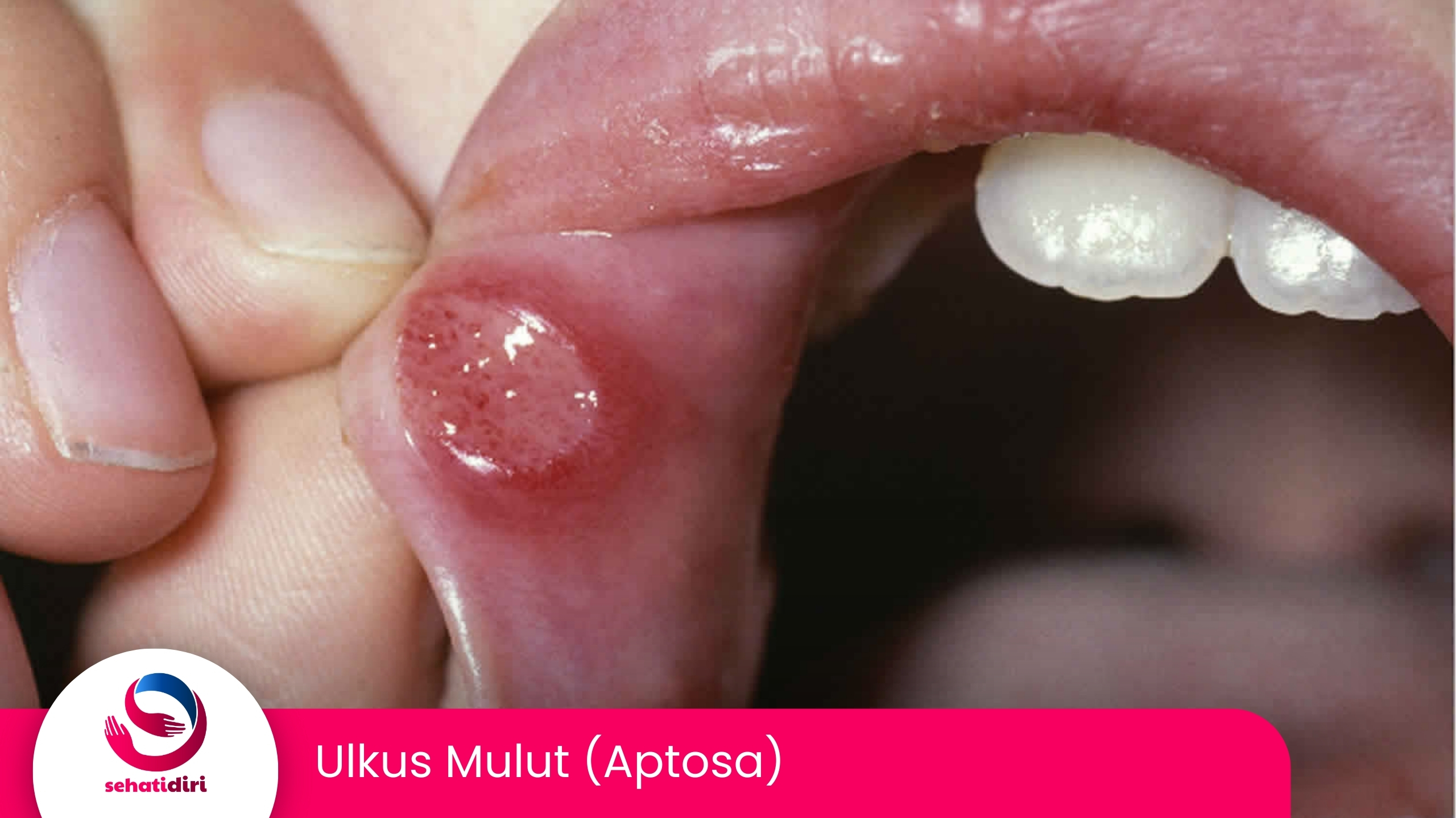 Ulkus Mulut (Aptosa)