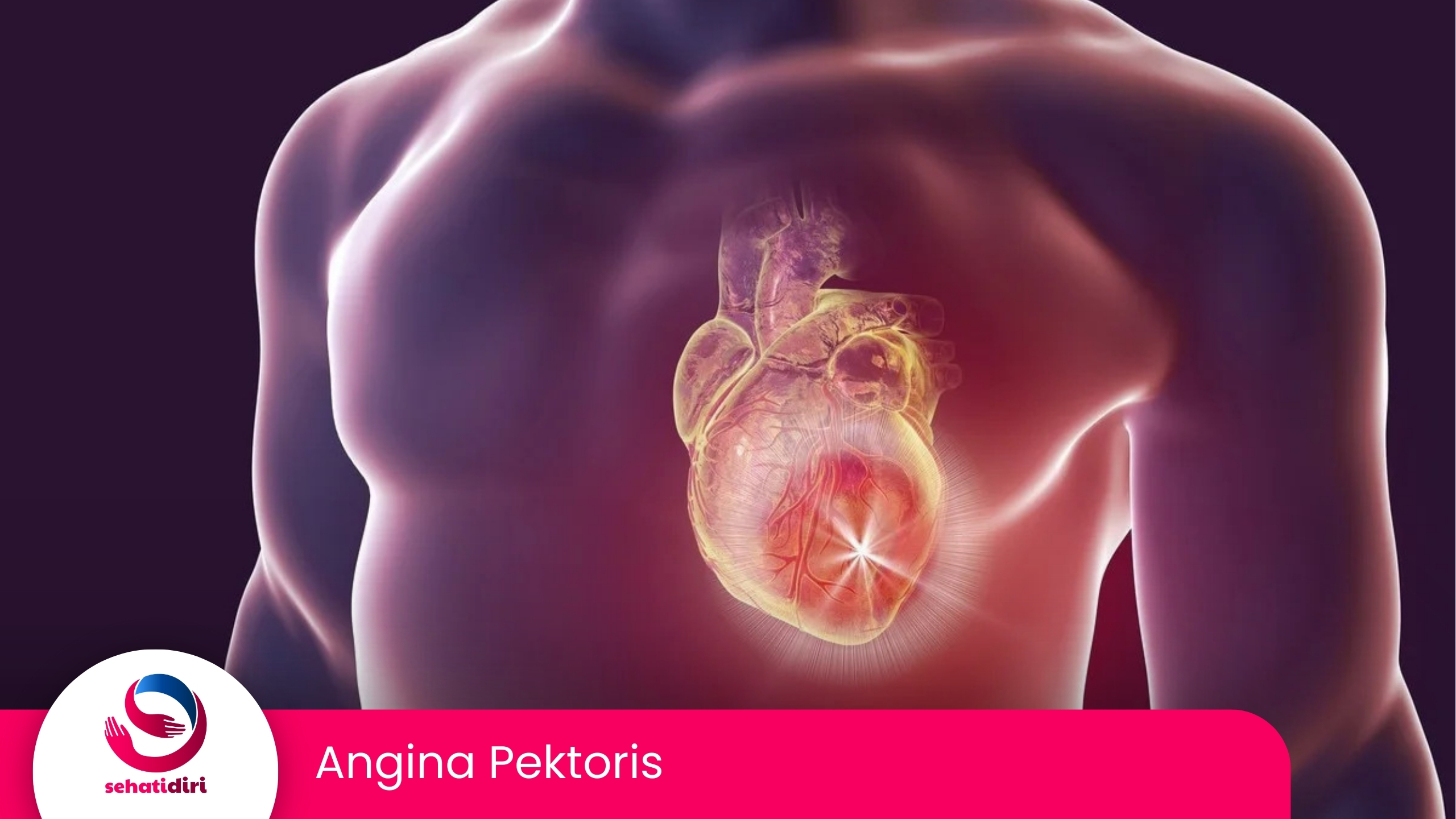 Angina Pektoris