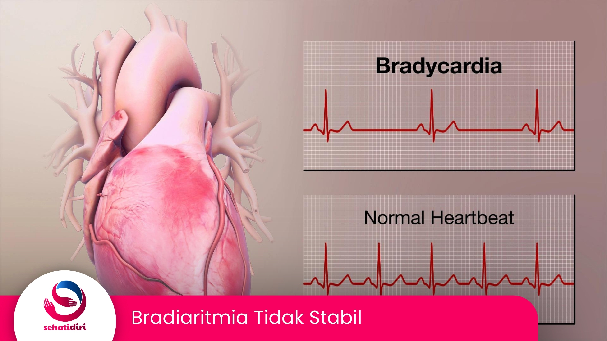 Bradiaritmia Tidak Stabil