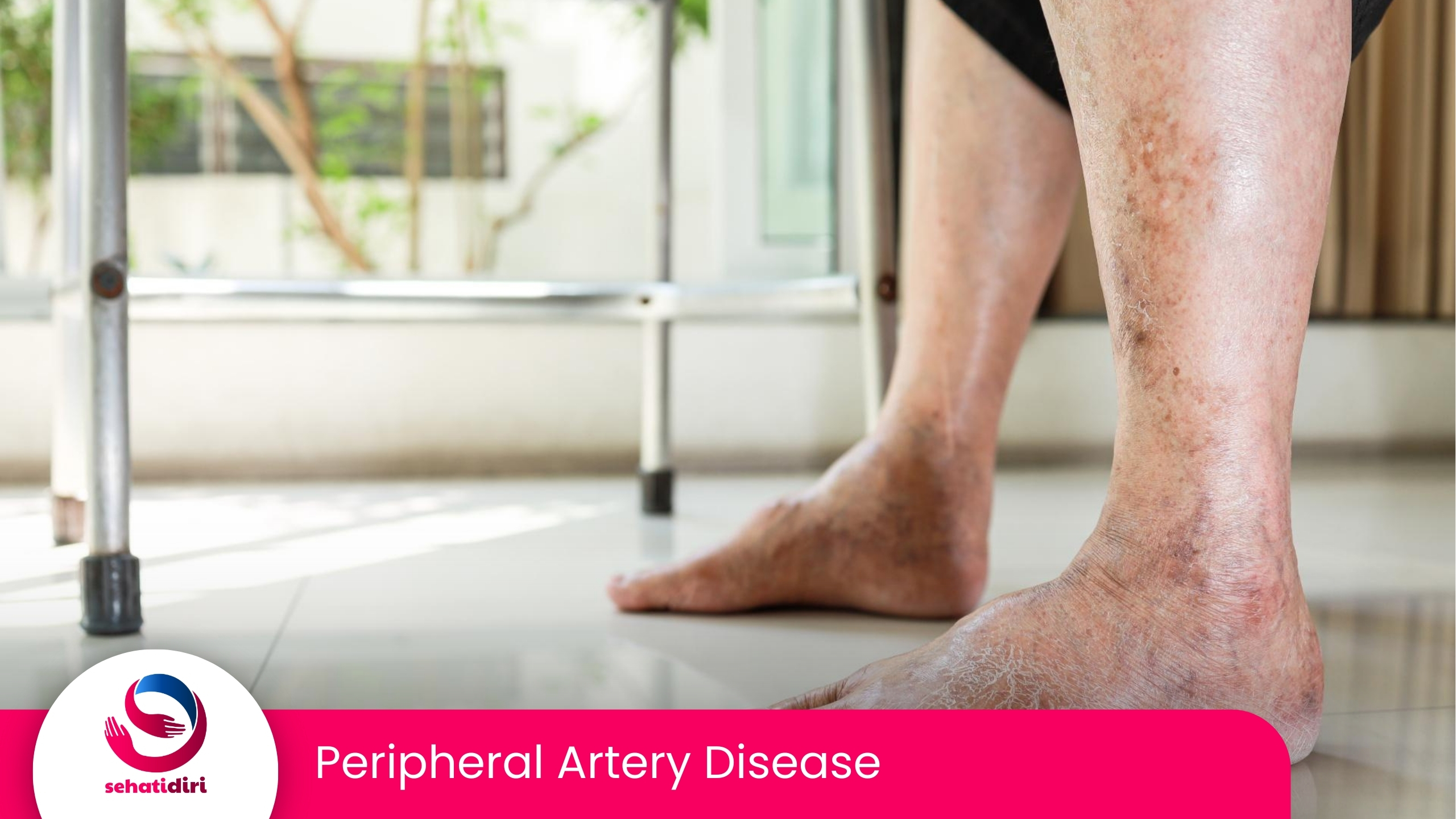 Peripheral Artery Disease