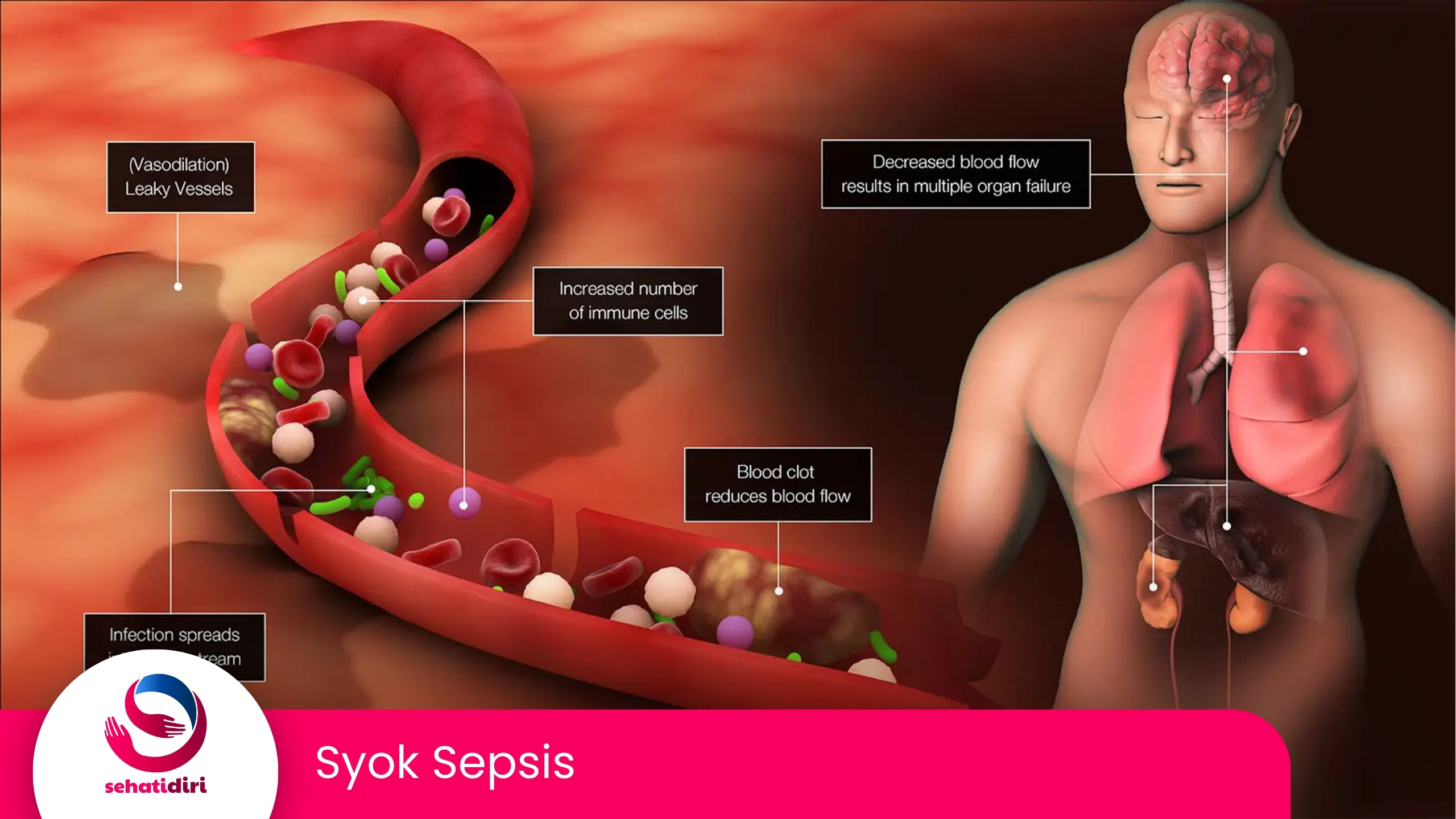 Syok Sepsis