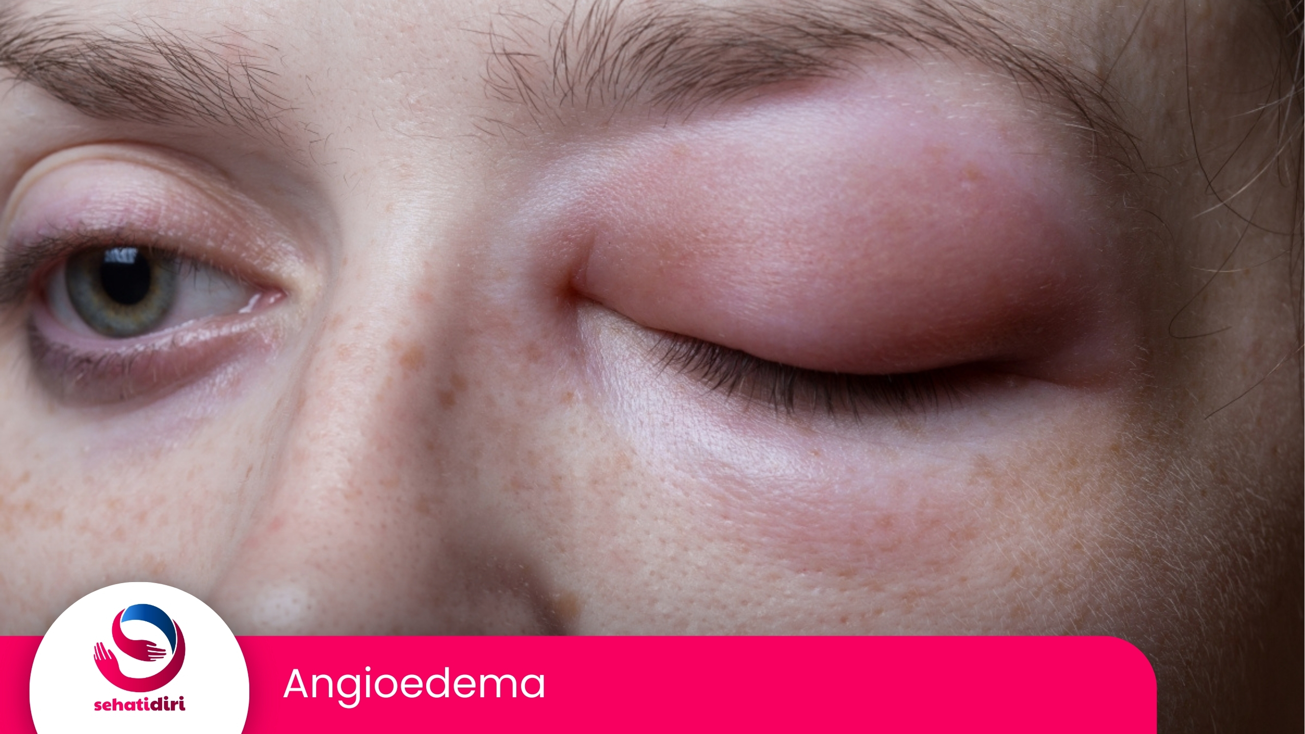 Angioedema