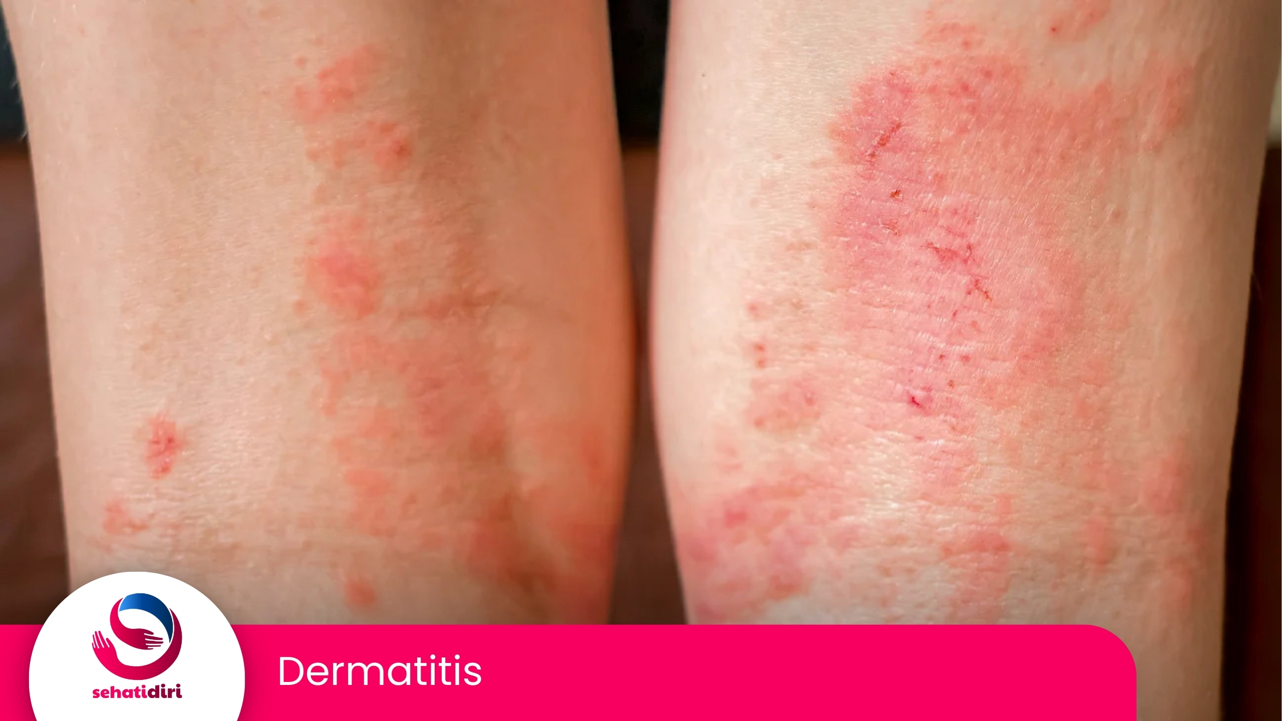 Dermatitis