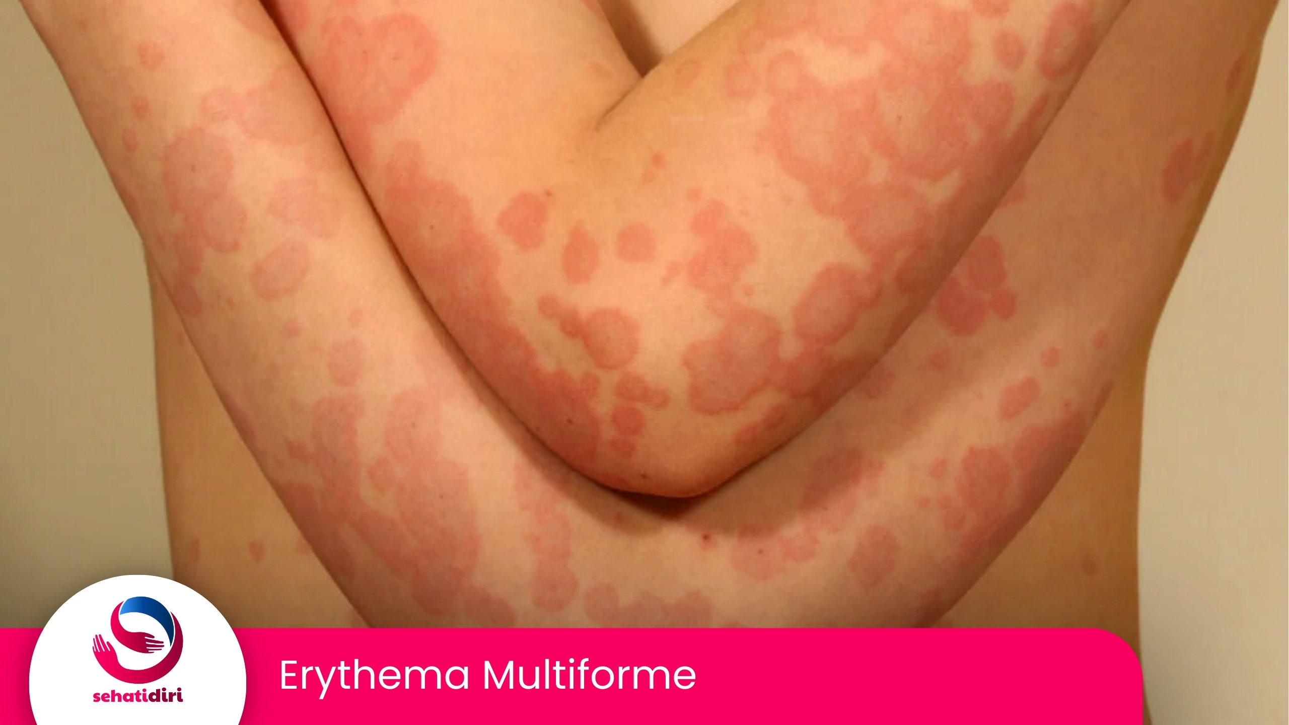 Erythema Multiforme