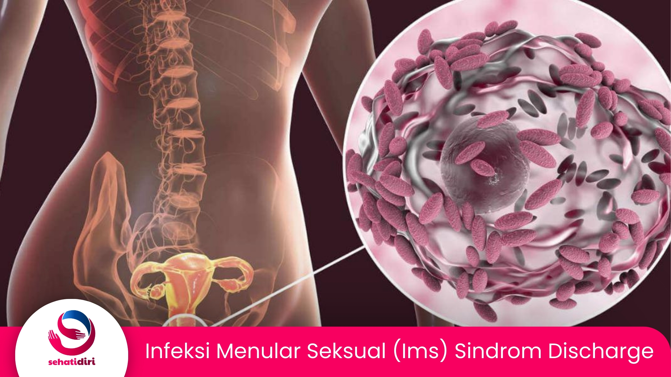 Infeksi Menular Seksual (IMS) Sindrom Discharge