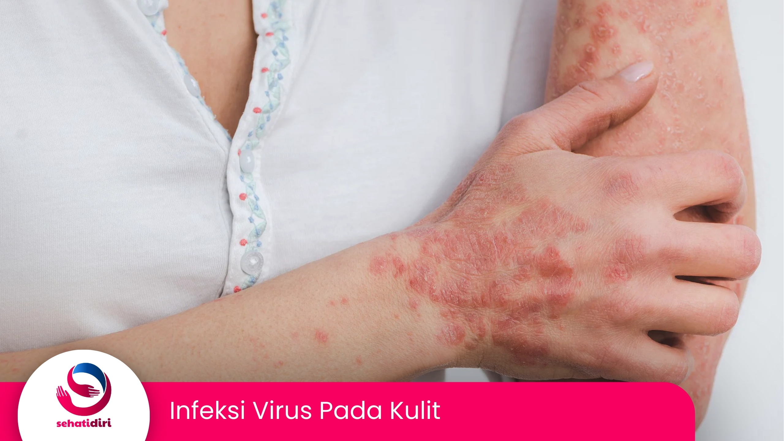 Infeksi Virus Pada Kulit