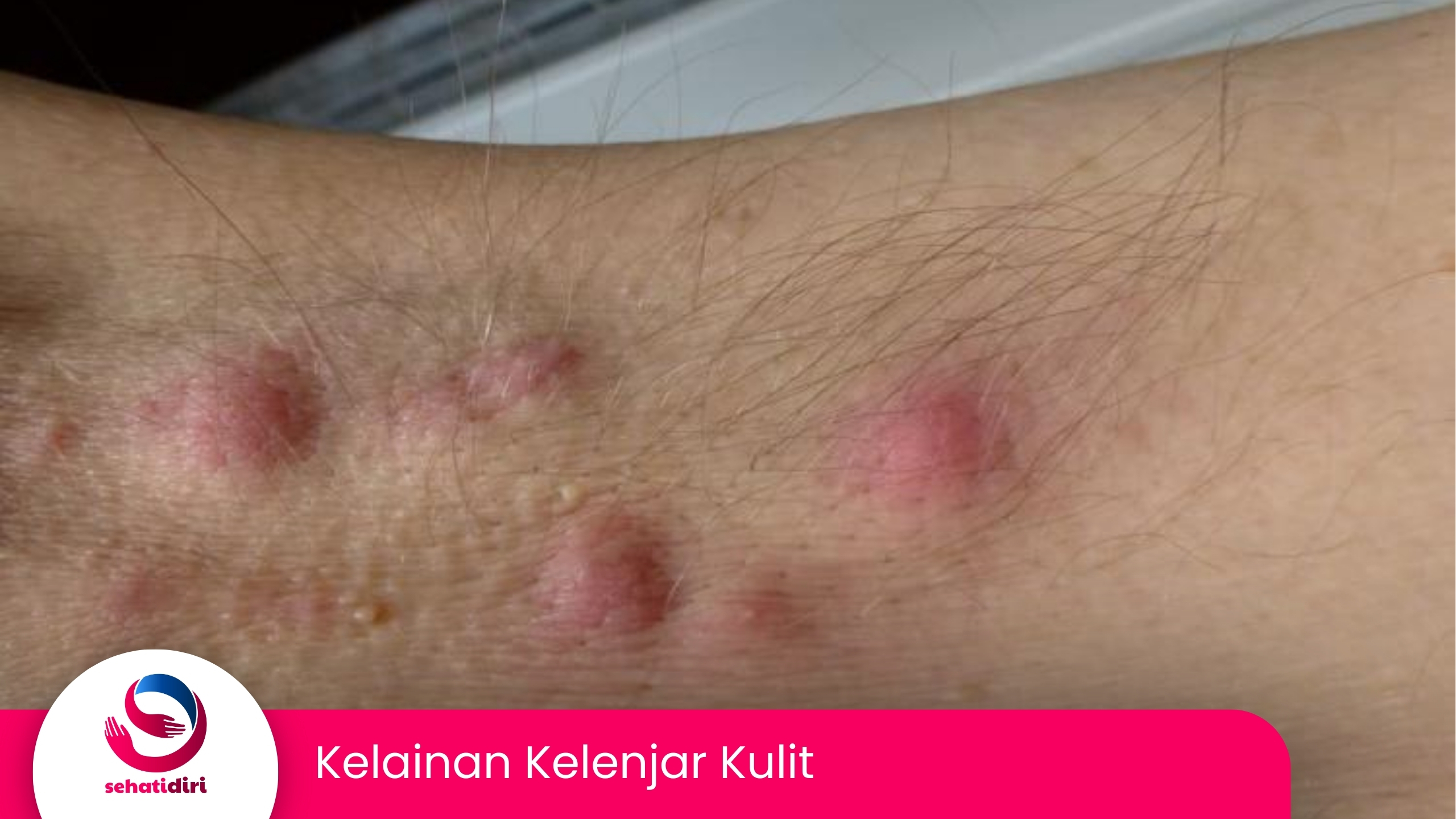 Kelainan Kelenjar Kulit