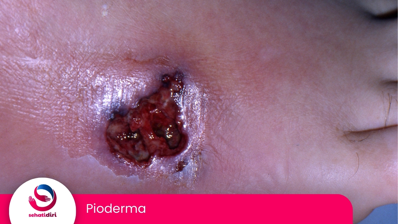 Pioderma (ICD-10 L08.0)