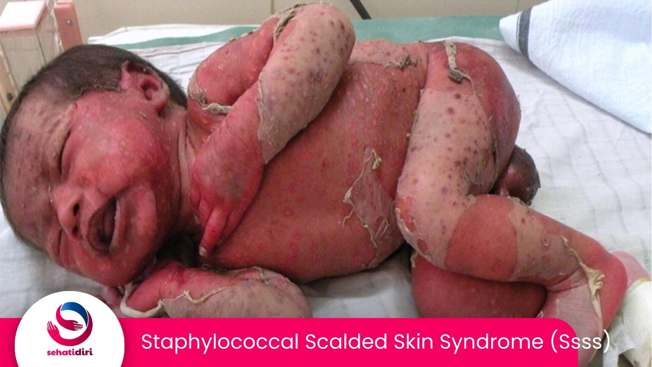 Staphylococcal Scalded Skin Syndrome (SSSS)