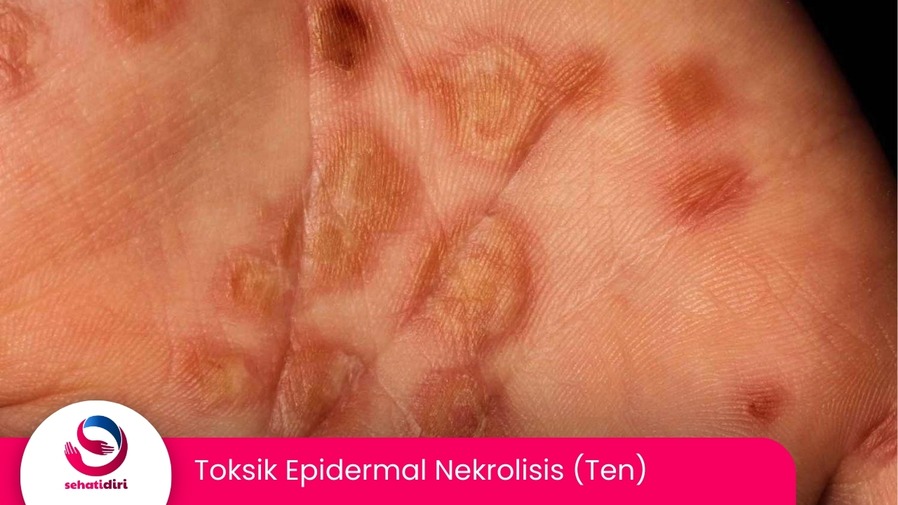 Toksik Epidermal Nekrolisis (TEN)