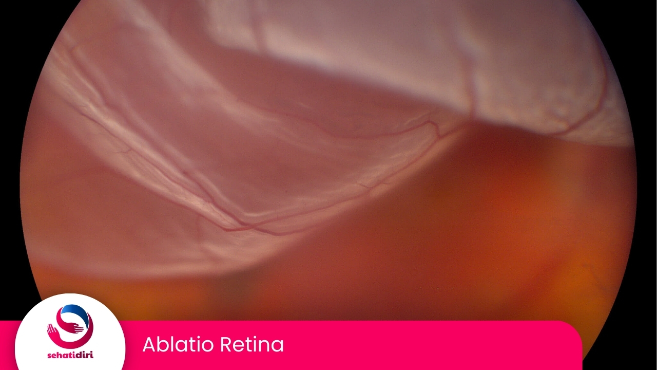 Ablasio Retina