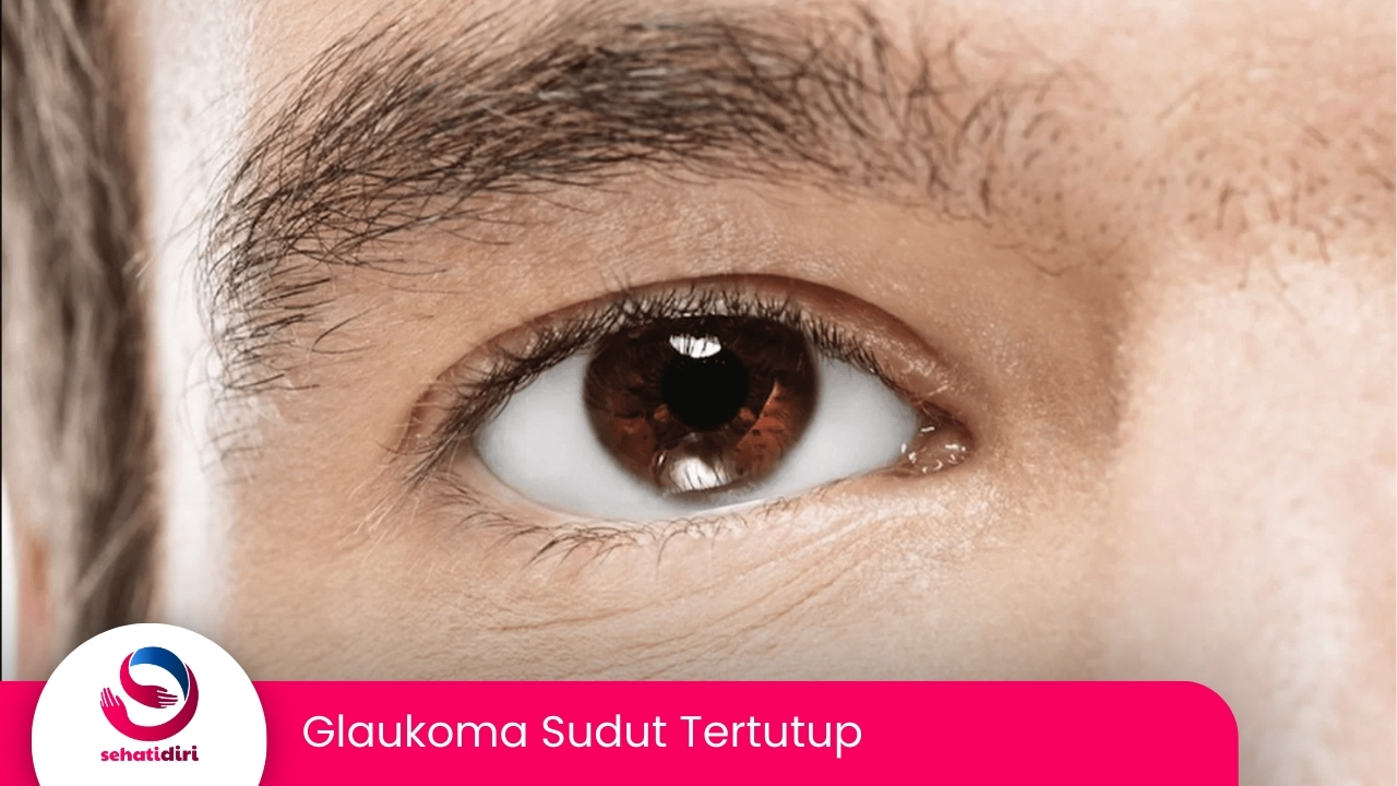 Glaukoma Sudut Tertutup