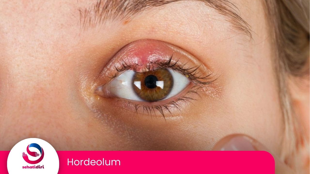 Hordeolum