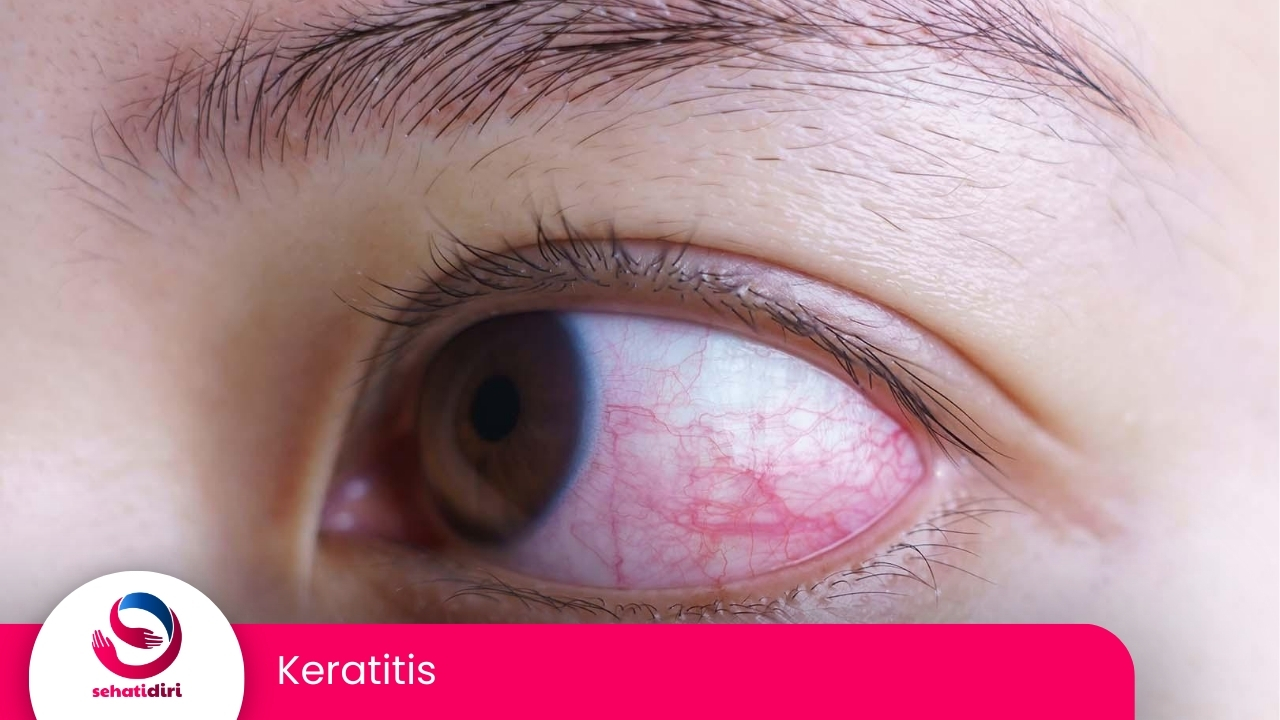 Keratitis