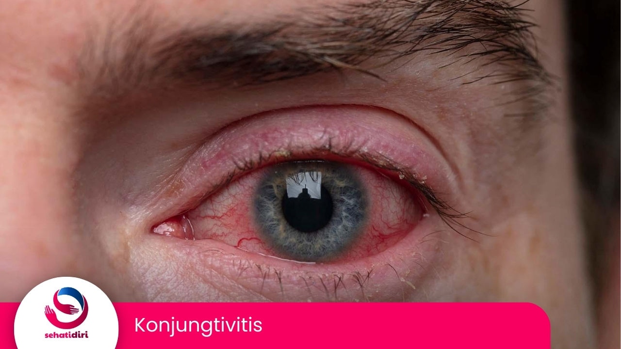 Konjungtivitis