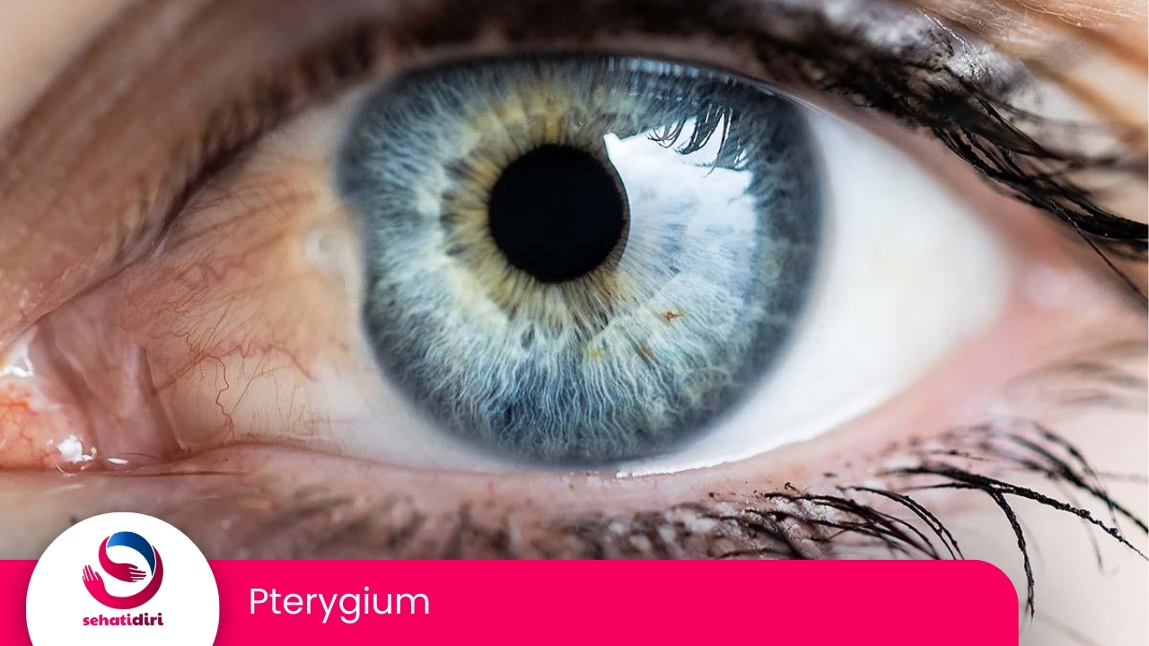 Pterygium