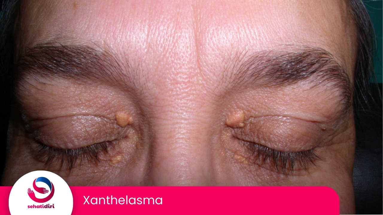 Xanthelasma