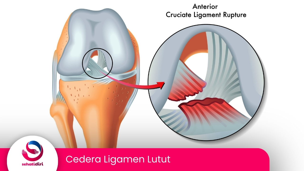 Cedera Ligamen Lutut