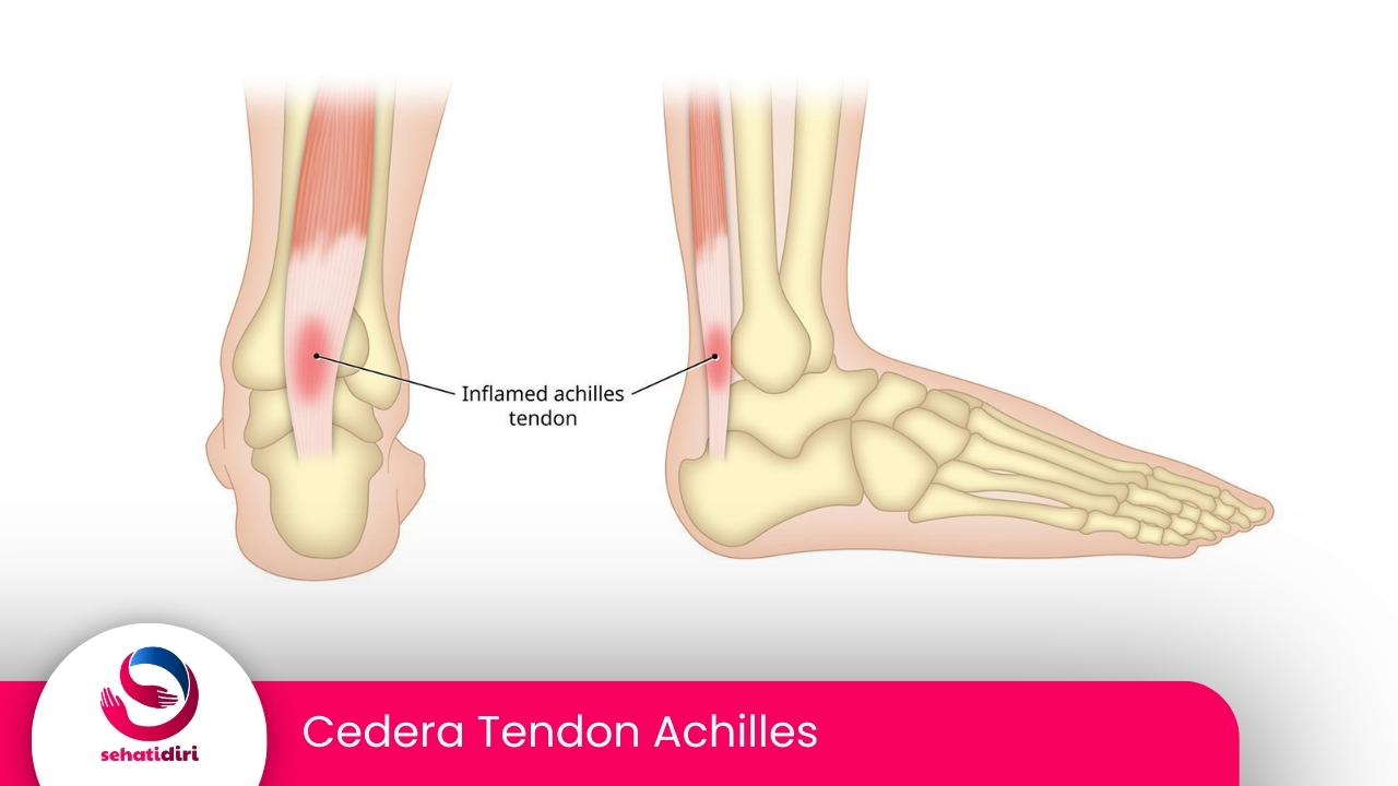 Cedera Tendon Achilles