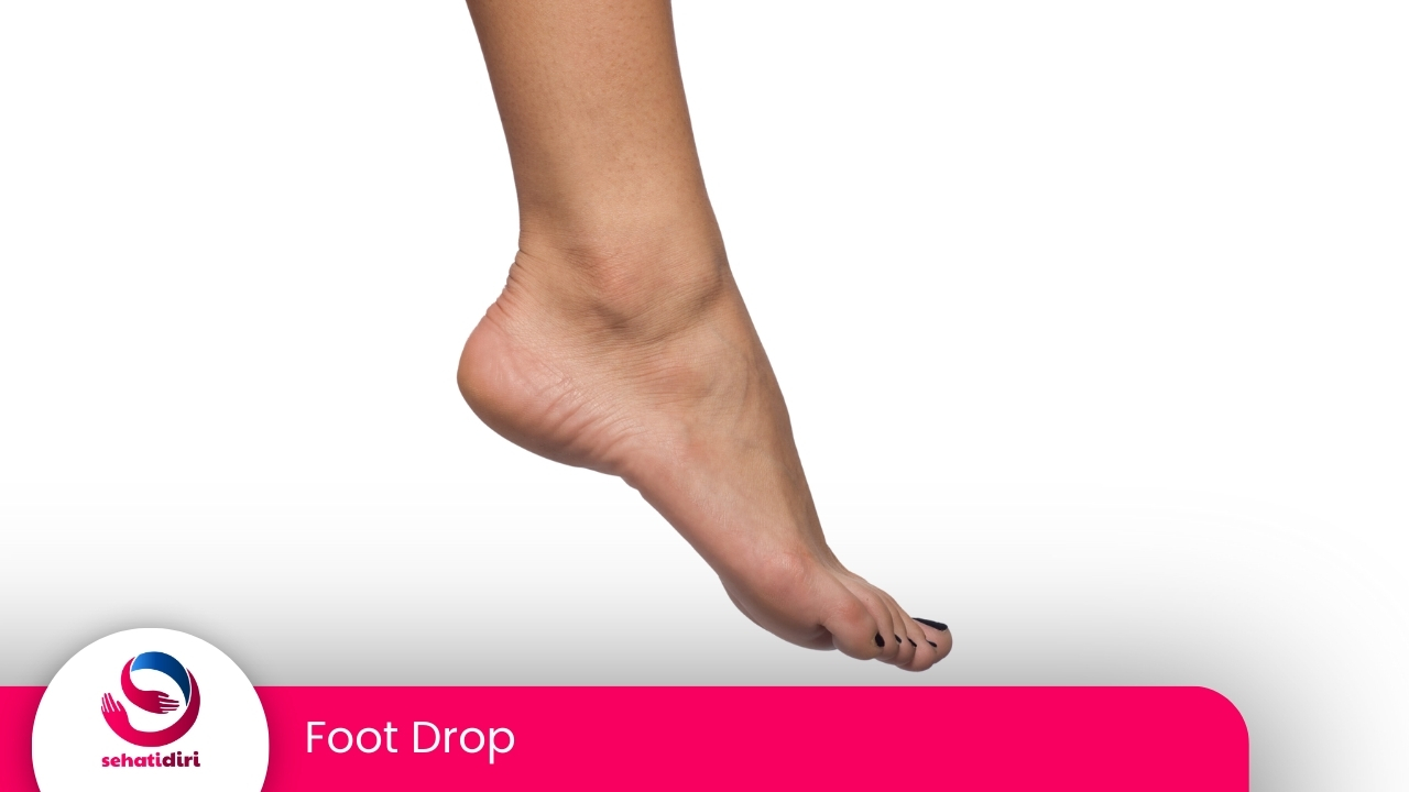 Foot Drop