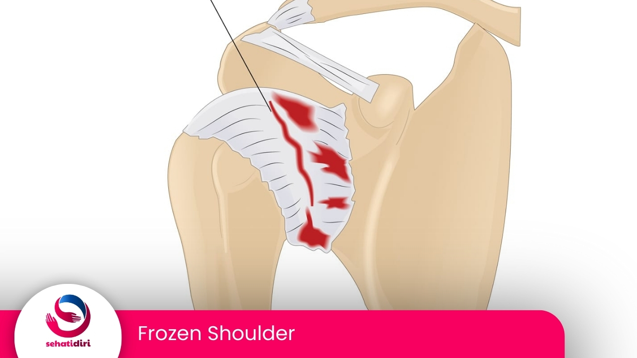 Frozen Shoulder