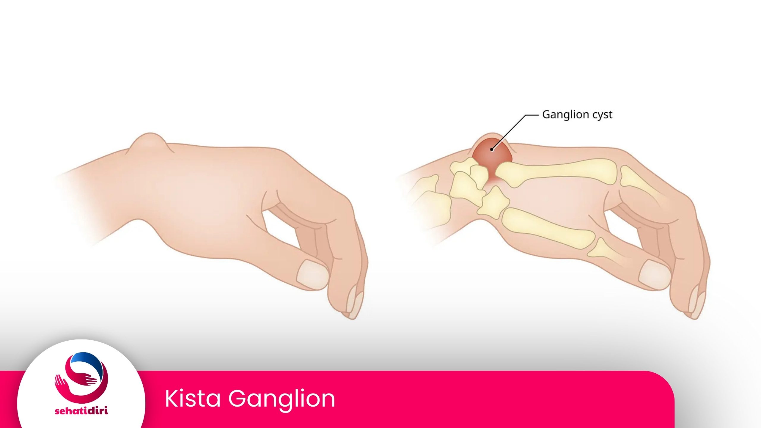 Kista Ganglion