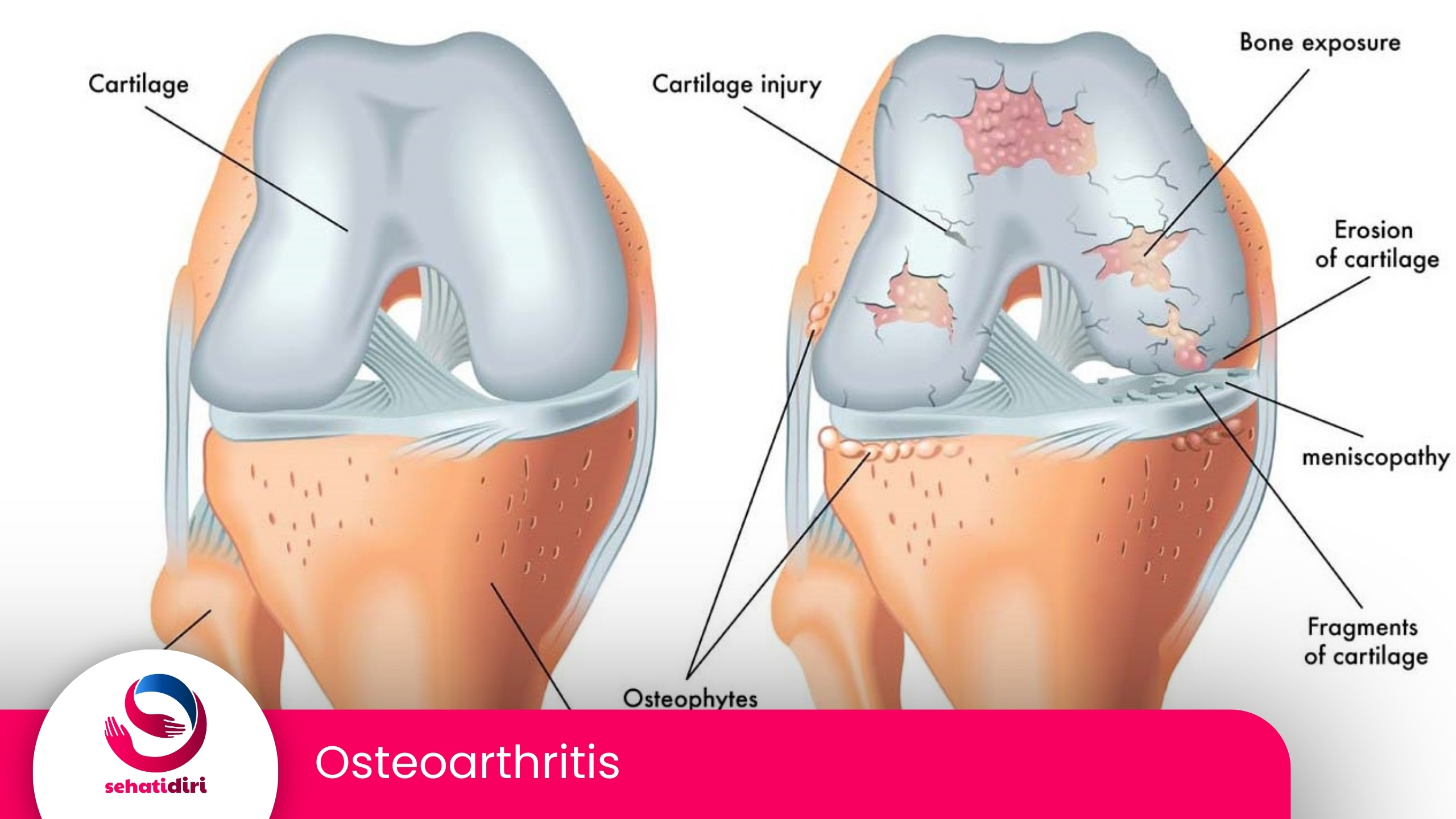 Osteoarthritis