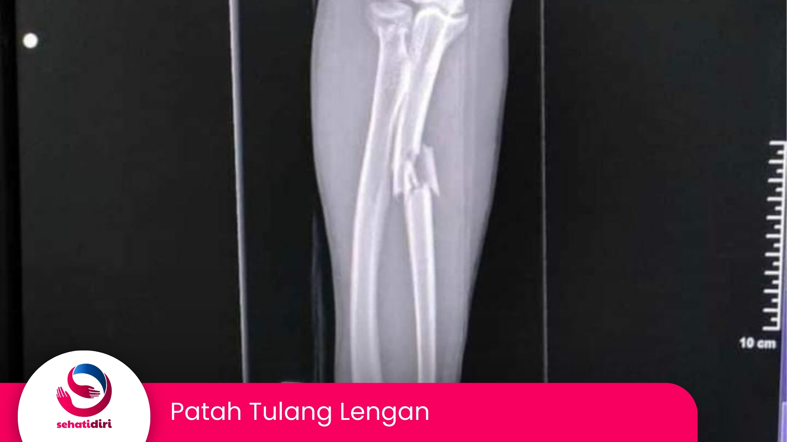 Patah Tulang Lengan