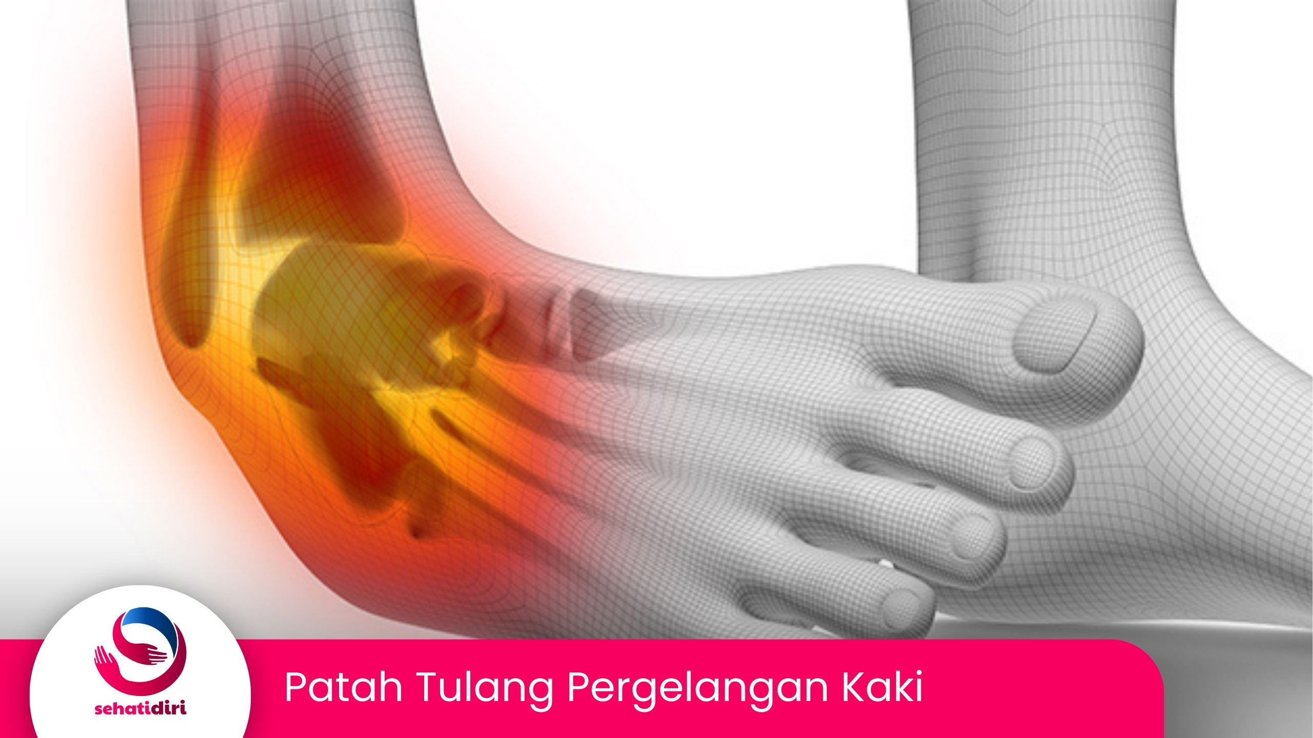 Patah Tulang Pergelangan Kaki