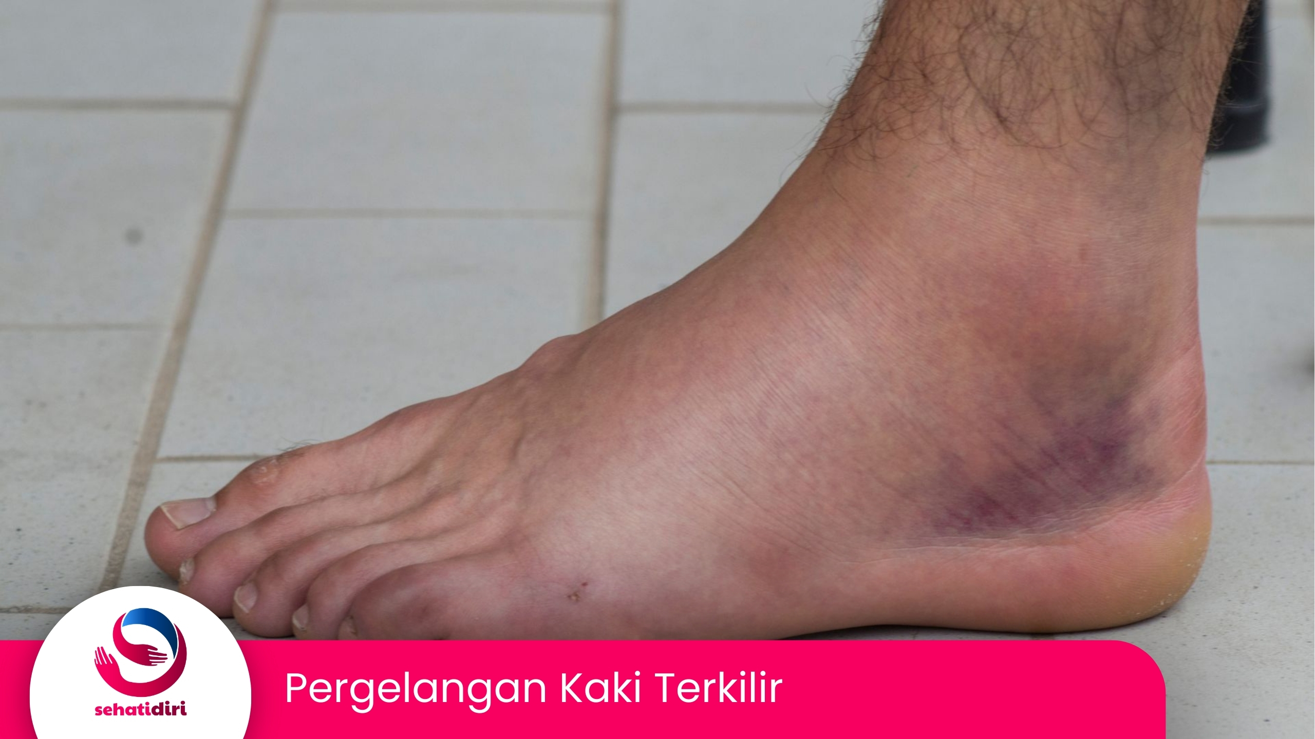 Pergelangan Kaki Terkilir