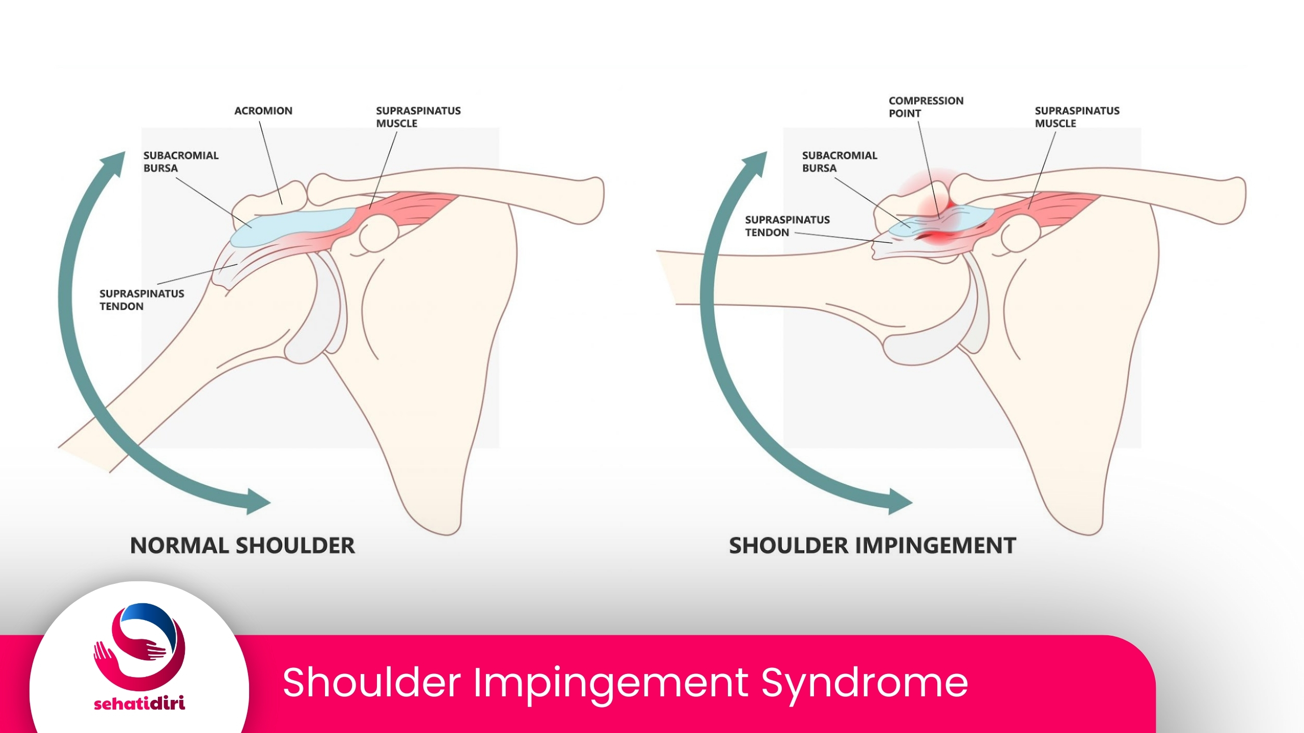 Shoulder Impingement Syndrome