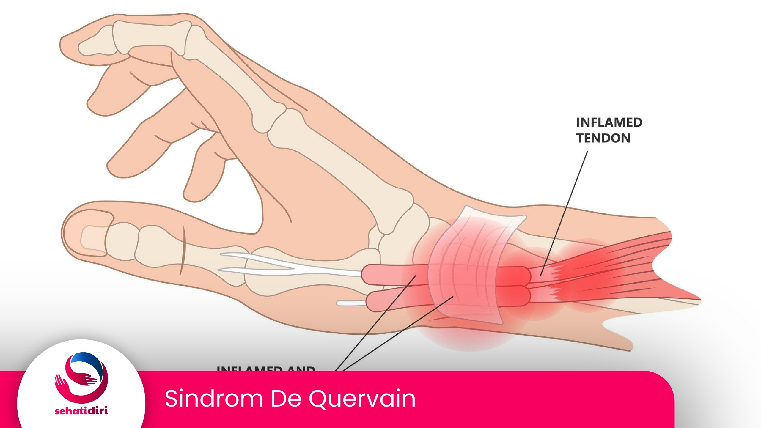 Sindrom De Quervain